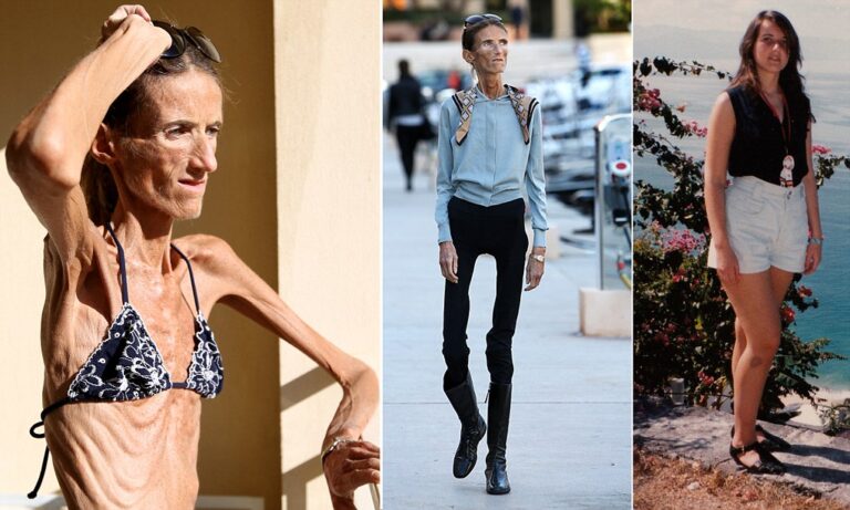 Woman Suffers From Extreme Anorexia