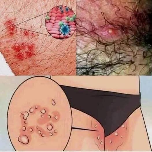 Groin Skin Problems Explained: Irritation, Rashes, and Prevention ...